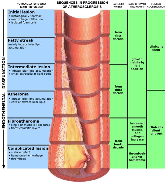 atherosclerosis